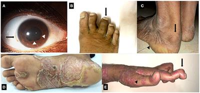 Spondyloarthritis and the Human Leukocyte Antigen (HLA)-B*27 Connection